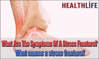 What Are The Symptoms Of A Stress Fracture