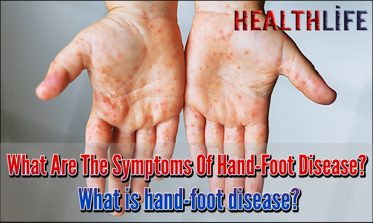 What Are The Symptoms Of Hand-Foot Disease