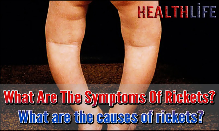 What Are The Symptoms Of Rickets