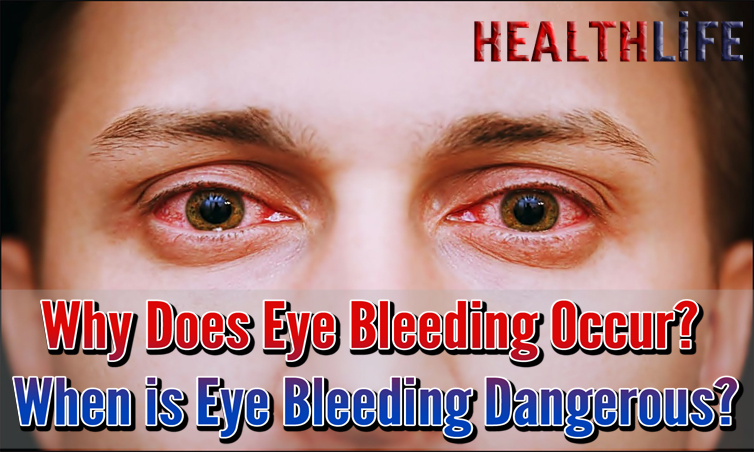 What Causes Bloodshot Eyes
