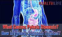 What Causes Pyloric Stenosis