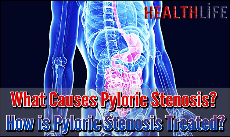 What Causes Pyloric Stenosis