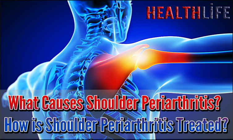 What Causes Shoulder Periarthritis