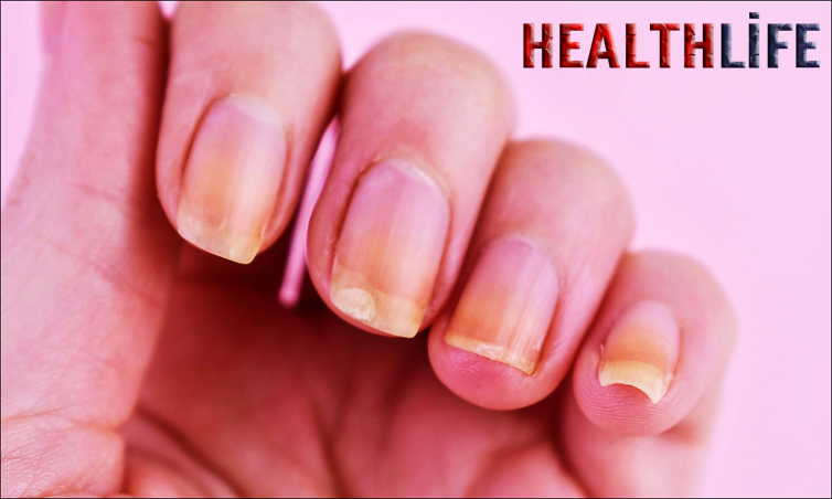 What Deficiency Causes Dark Nails