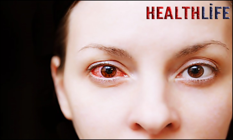 What Is The Main Cause Of Bloodshot Eyes