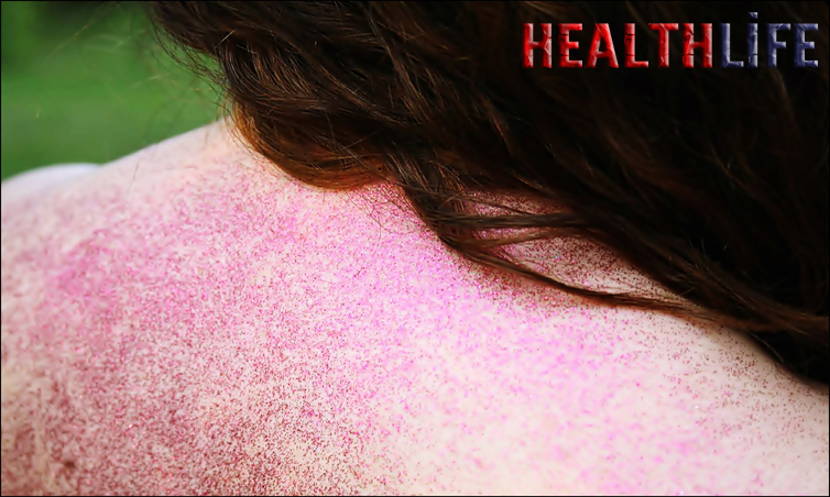 What Triggers Adult Onset Stil's Disease