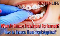 When Is Braces Treatment Performed