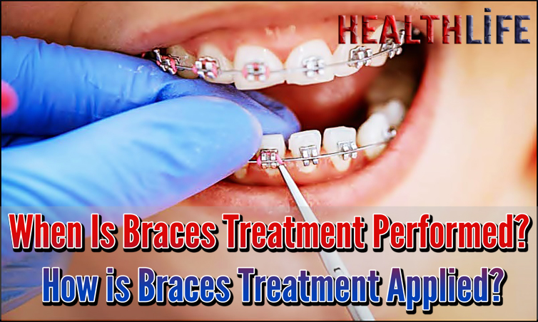 When Is Braces Treatment Performed