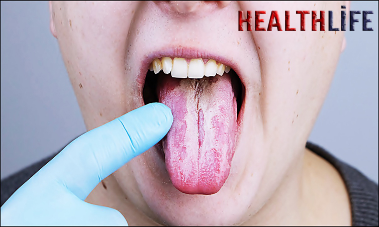 Which Deficiency Causes Tongue Ulcers