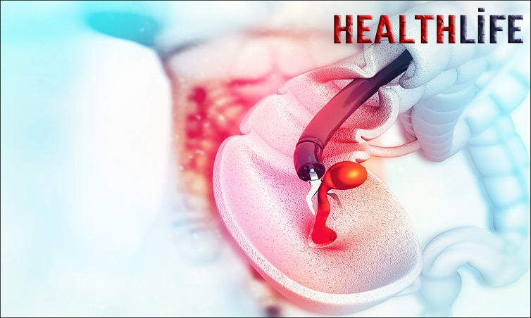 Who Cannot Have A Colonoscopy