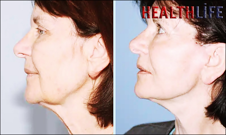 Who Is Not A Good Candidate For A Neck Lift