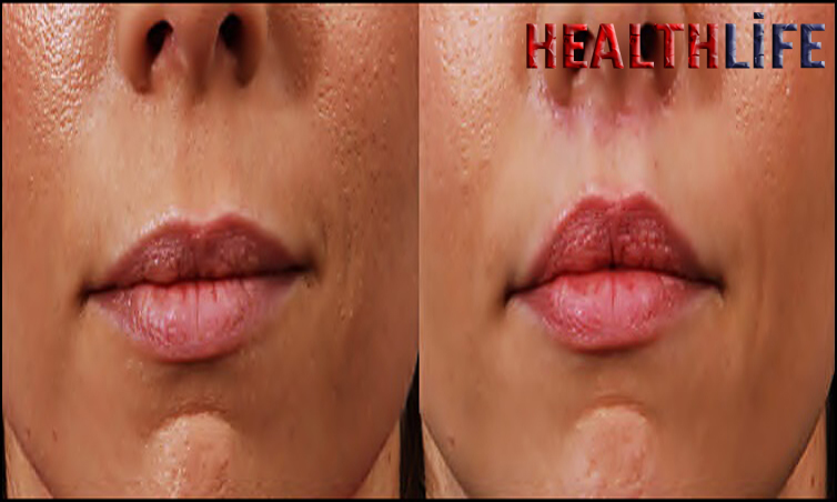 Who Should Not Get A Lip Lift