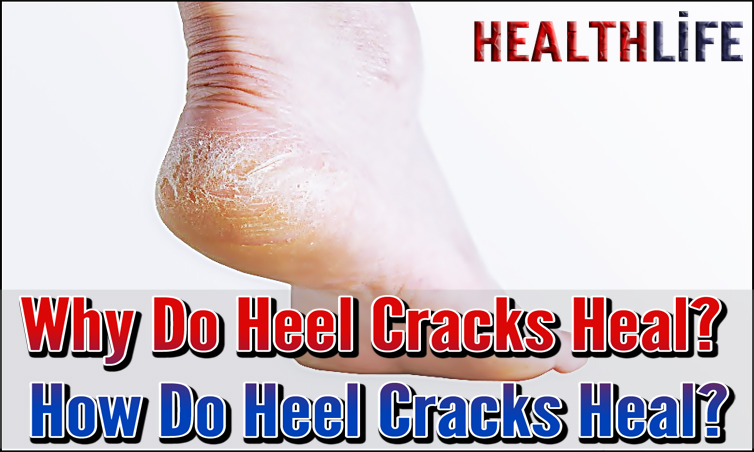Why Do Heels Crack