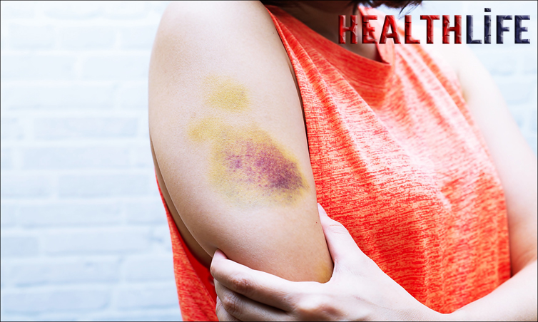 Why Is My Wrist Bruising For No Reason