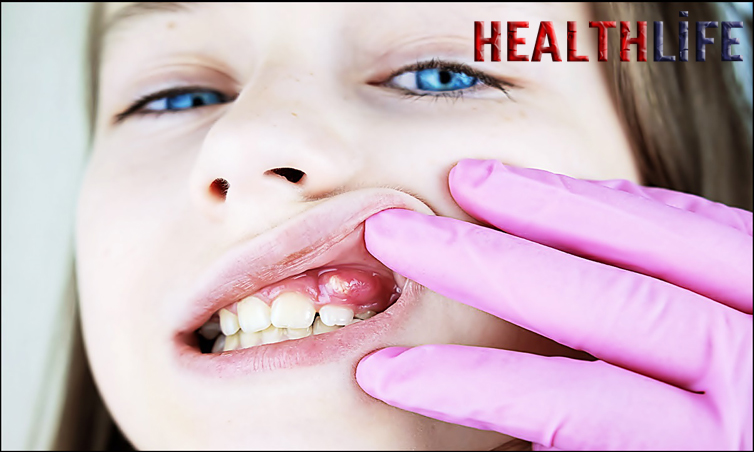 Will A Tooth Infection Pass On Its Own