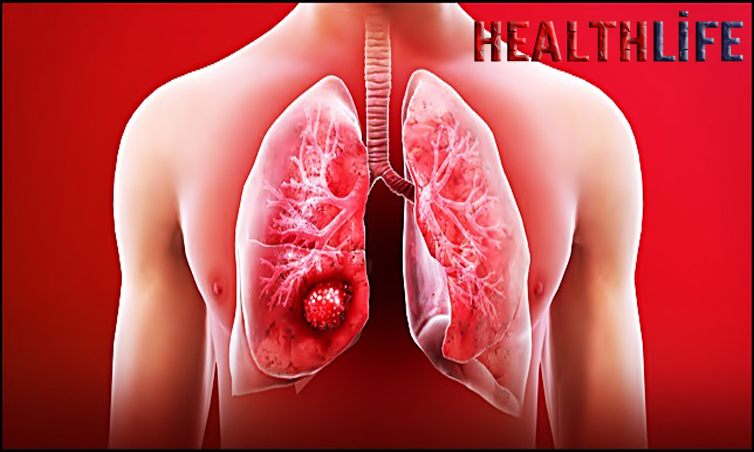 Can Lung Cancer Be Avoided
