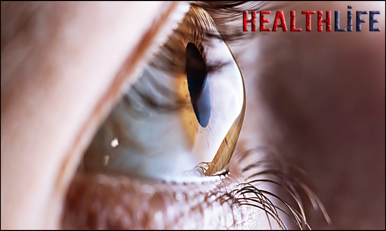 How Do You Know If You Have Keratoconus