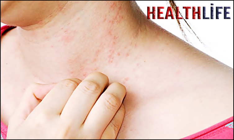 How Long Does A Soap Allergy Last