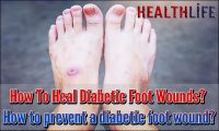 How To Heal Diabetic Foot Wounds