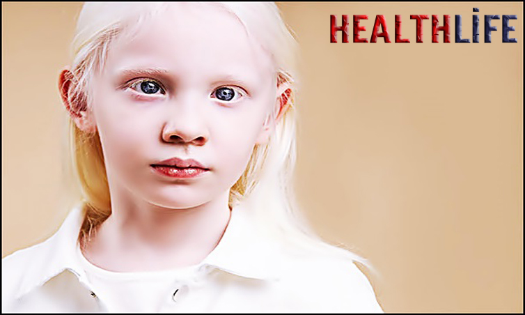 What Are The Symptoms Of Albinism Skin