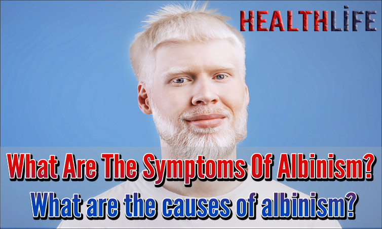 What Are The Symptoms Of Albinism