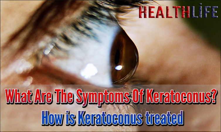 What Are The Symptoms Of Keratoconus