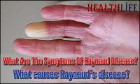 What Are The Symptoms Of Raynaud Disease