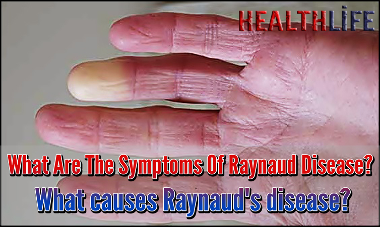 What Are The Symptoms Of Raynaud Disease