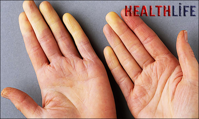 When To Worry About Raynauds