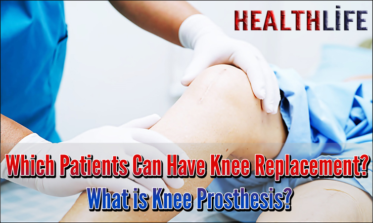 Which Patients Can Have Knee Replacement
