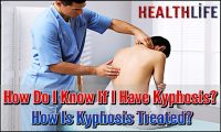 How Do I Know If I Have Kyphosis