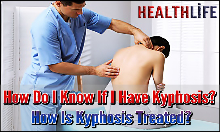 How Do I Know If I Have Kyphosis