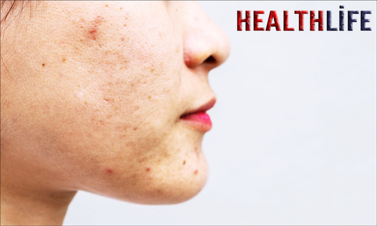How Do You Deep Clean Clogged Pores