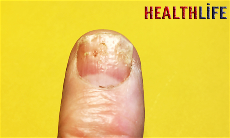 How Do You Know If You Have Nail Psoriasis