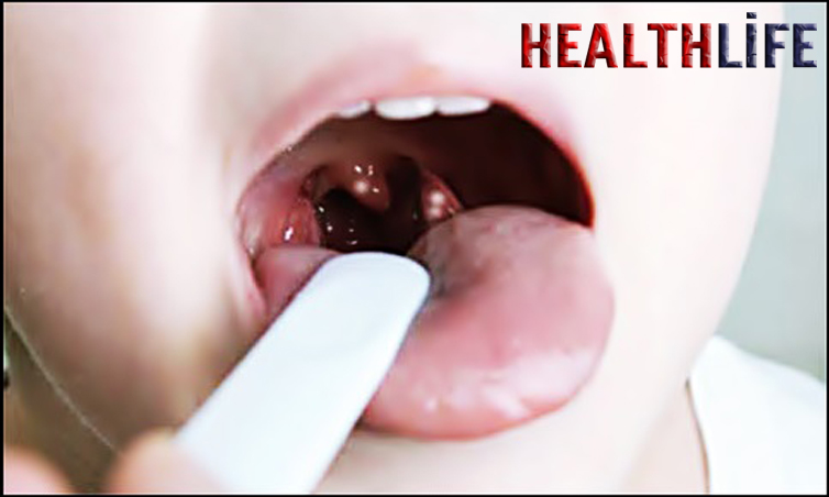 How Does A Child Get A Throat Infection