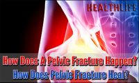 How Does A Pelvic Fracture Happen