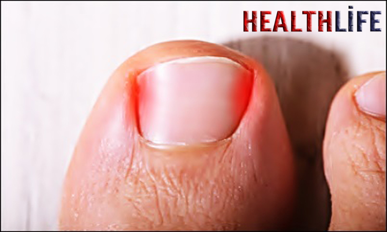 How To Relieve Nail Pain