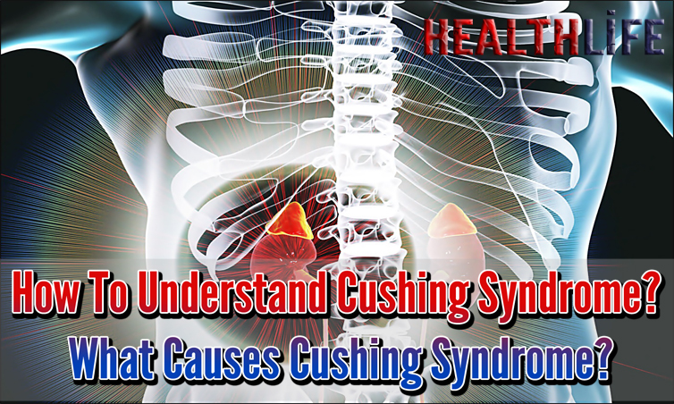 How To Understand Cushing Syndrome