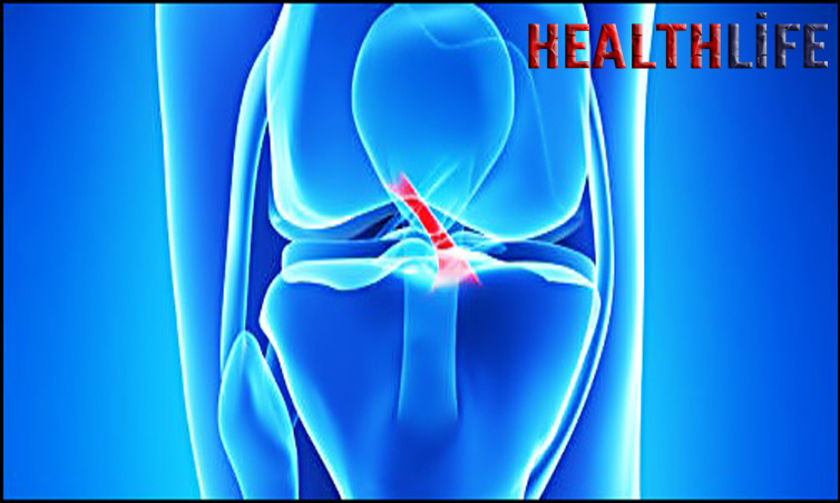 Is A Forn Anterior Cruciate Ligament Serious