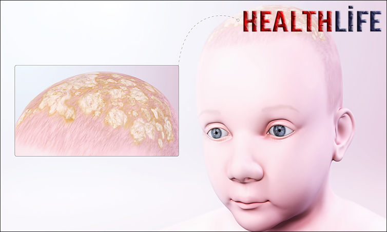 Should You Remove Cradle Cap Or Leave It Alone