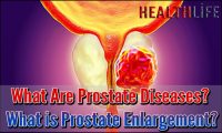 What Are Prostate Diseases