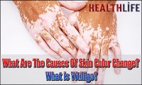 What Are The Causes Of Skin Color Change