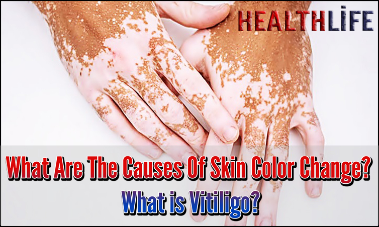 What Are The Causes Of Skin Color Change
