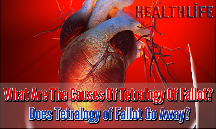 What Are The Causes Of Tetralogy Of Fallot