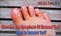 What Are The Symptoms Of Hammer Toe