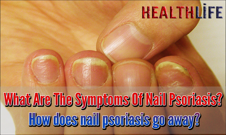 What Are The Symptoms Of Nail Psoriasis