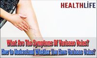 What Are The Symptoms Of Varicose Veins
