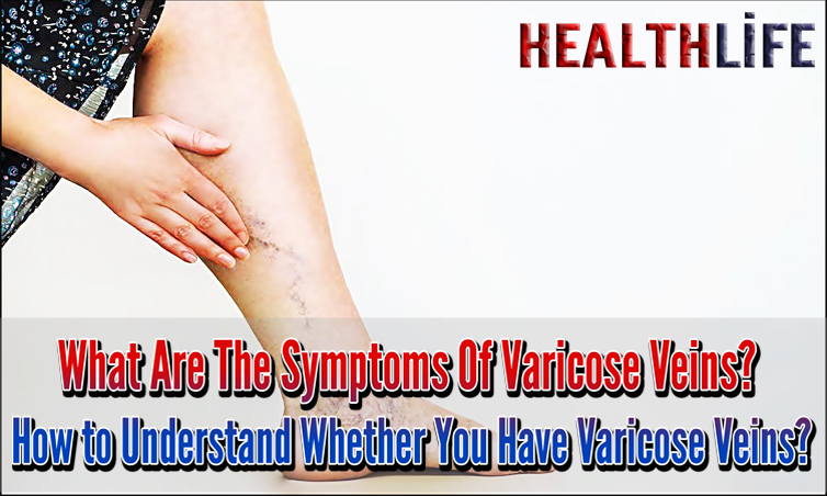 What Are The Symptoms Of Varicose Veins
