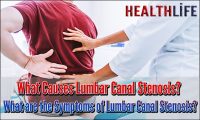 What Causes Lumbar Canal Stenosis
