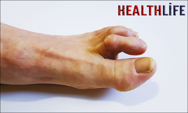 What Does Hammertoe Pain Feel Like